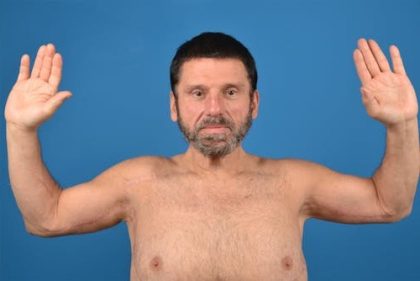 Brachioplasty Before & After Patient #1292