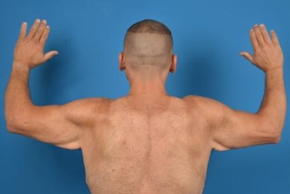 Brachioplasty Before & After Patient #1292
