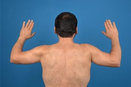 Brachioplasty Before & After Patient #1292