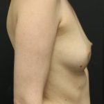 Breast Augmentation Before & After Patient #1248
