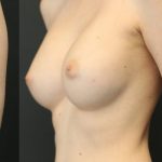 Breast Augmentation Before & After Patient #1248