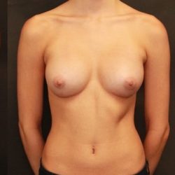 Breast Augmentation Before & After Patient #1246