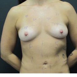 Breast Augmentation Before & After Patient #1245