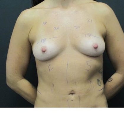 Breast Augmentation Before & After Patient #1245