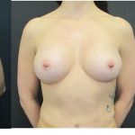 Breast Augmentation Before & After Patient #1245