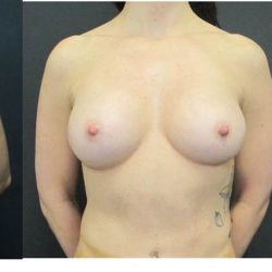 Breast Augmentation Before & After Patient #1245