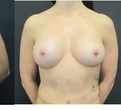 Breast Augmentation Before & After Patient #1245