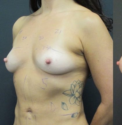 Breast Augmentation Before & After Patient #1245