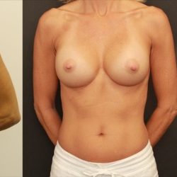 Breast Augmentation Before & After Patient #1244