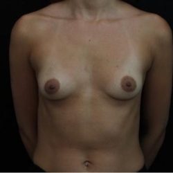 Breast Augmentation Before & After Patient #1243