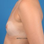 Breast Augmentation Before & After Patient #1238