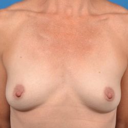 Breast Augmentation Before & After Patient #1235