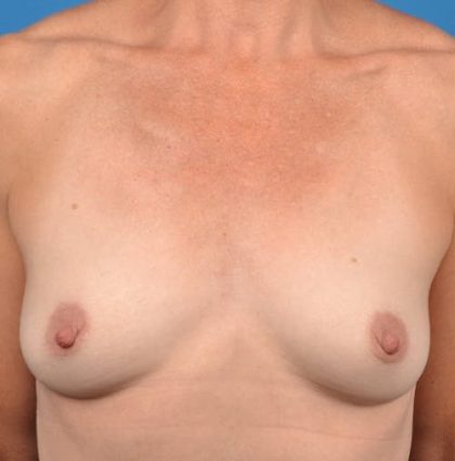 Breast Augmentation Before & After Patient #1235