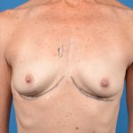 Breast Augmentation Before & After Patient #1233
