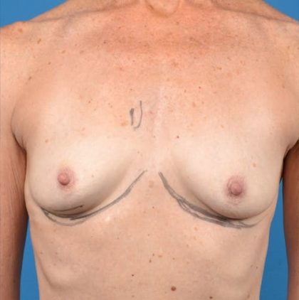 Breast Augmentation Before & After Patient #1233