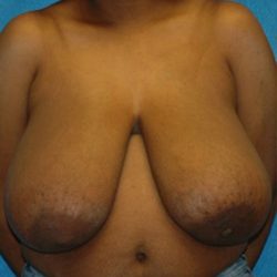 Breast Lift Before & After Patient #1259