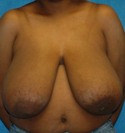 Breast Lift Before & After Patient #1259
