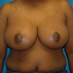 Breast Lift Before & After Patient #1259