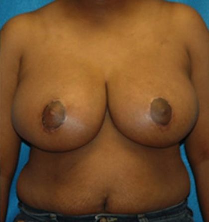 Breast Lift Before & After Patient #1259