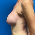 Breast Lift Before & After Patient #1255