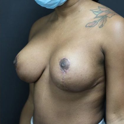 Breast Lift Before & After Patient #1251