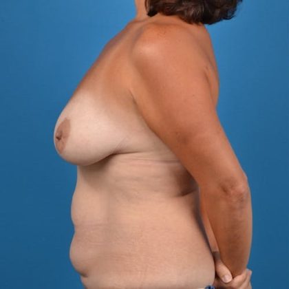 Breast Lift Before & After Patient #1249