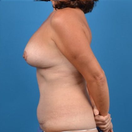 Breast Lift Before & After Patient #1249