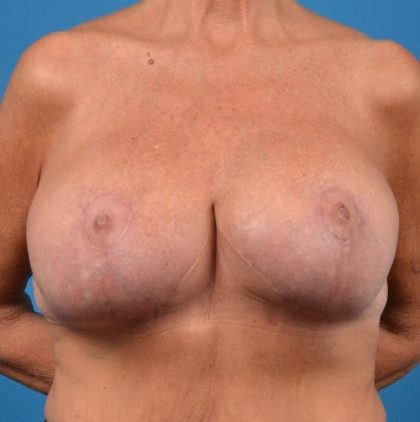 Breast Augmentation Revision Before & After Patient #1263