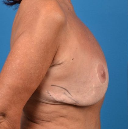 Breast Augmentation Revision Before & After Patient #1263