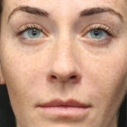 Dysport Before & After Patient #1324