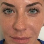 Dysport Before & After Patient #1324