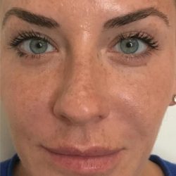 Dysport Before & After Patient #1324