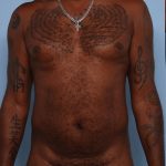 Emsculpt Before & After Patient #1322