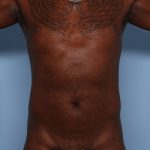 Emsculpt Before & After Patient #1322