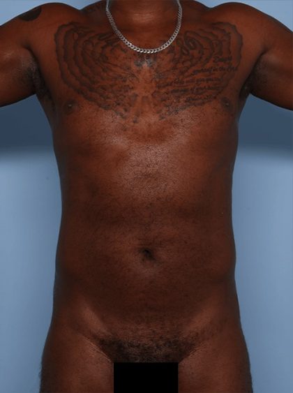 Emsculpt Before & After Patient #1322