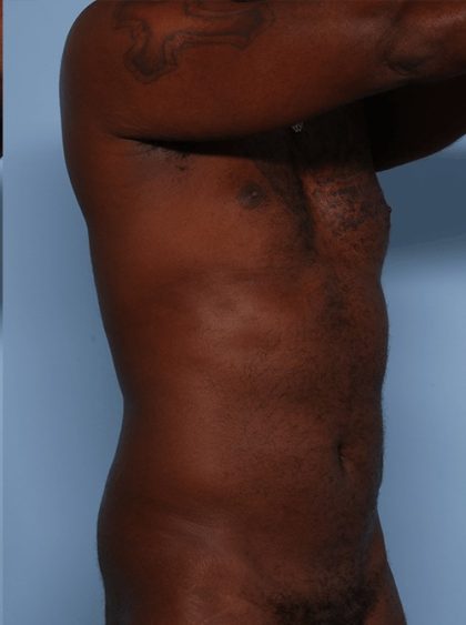Emsculpt Before & After Patient #1322