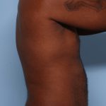 Emsculpt Before & After Patient #1322