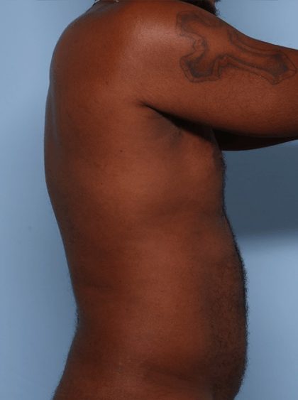 Emsculpt Before & After Patient #1322