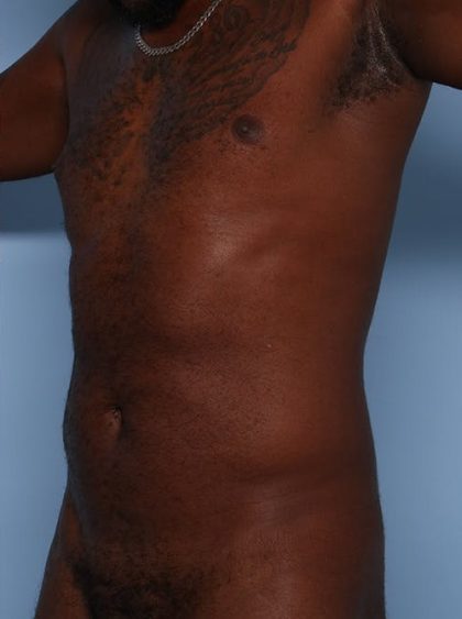 Emsculpt Before & After Patient #1322