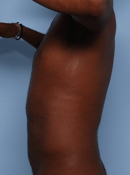 Emsculpt Before & After Patient #1322