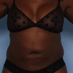 Emsculpt Before & After Patient #1321