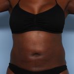 Emsculpt Before & After Patient #1321