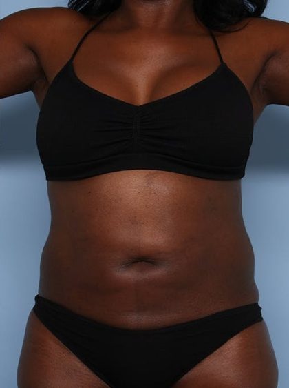Emsculpt Before & After Patient #1321