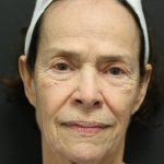 Facelift Before & After Patient #1186