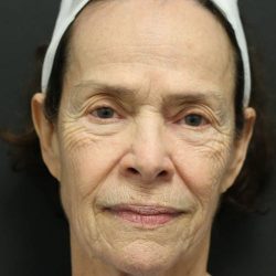 Facelift Before & After Patient #1186