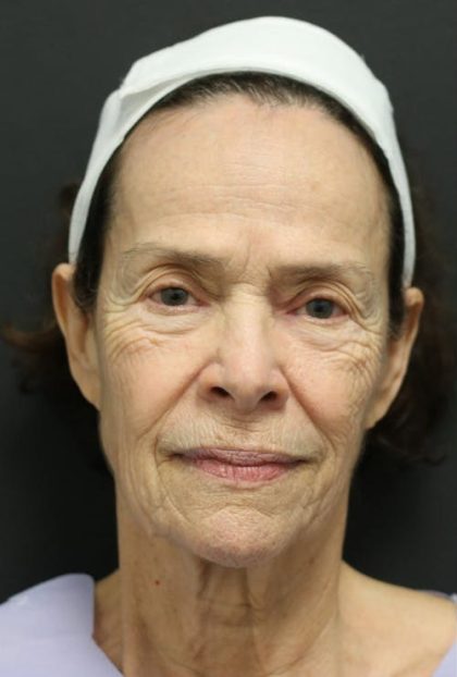 Facelift Before & After Patient #1186