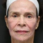 Facelift Before & After Patient #1186