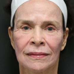 Facelift Before & After Patient #1186