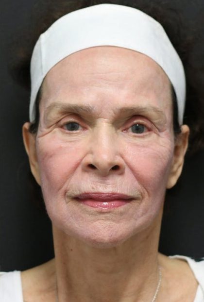 Facelift Before & After Patient #1186