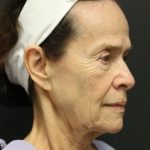 Facelift Before & After Patient #1186